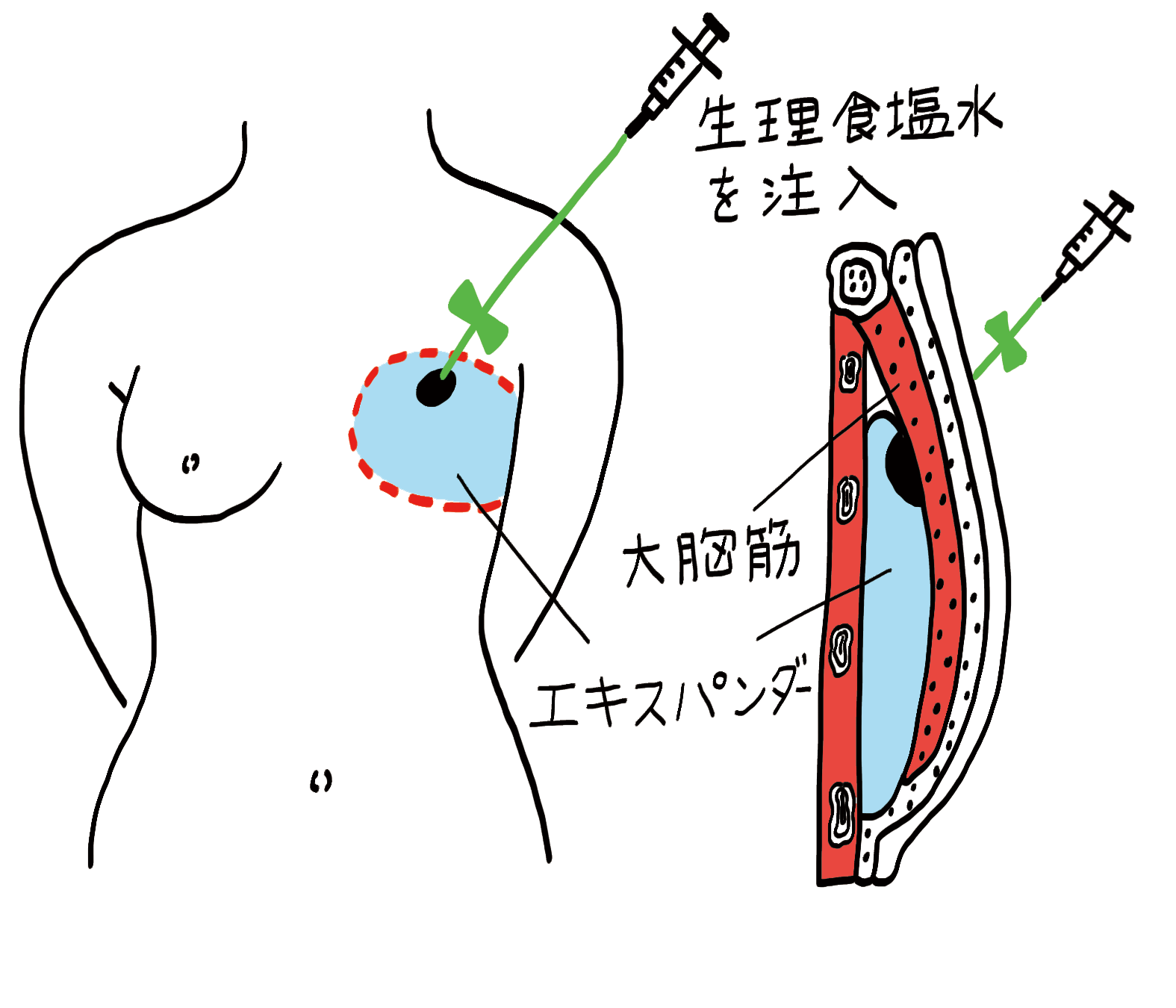 乳房再建手術