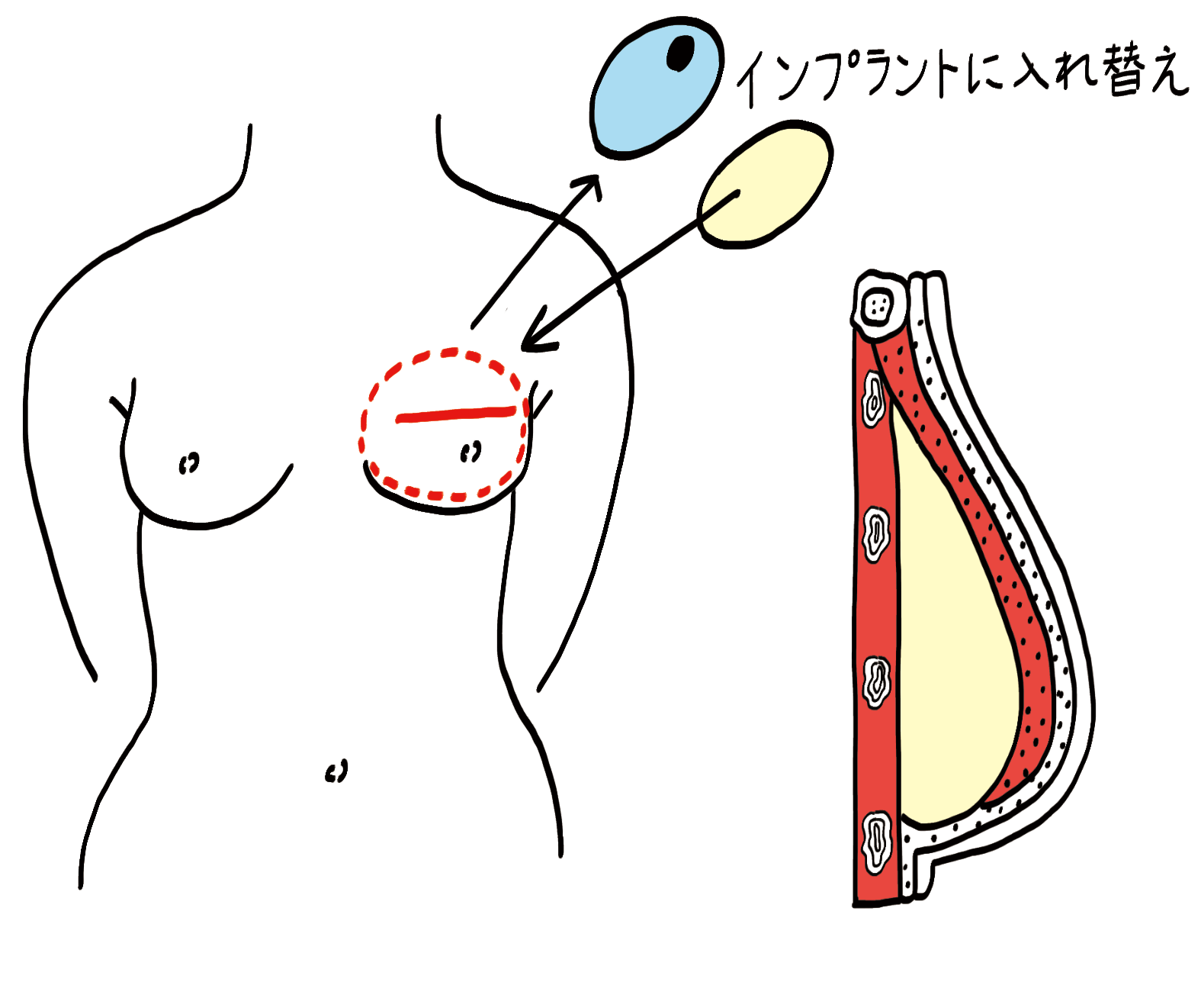 乳房再建手術