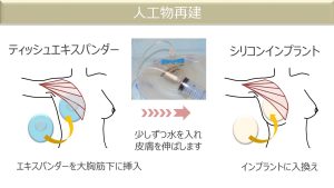 10．理論に基づいた術式別・時期別 下着の選び方 | E-BeC(エンパワ